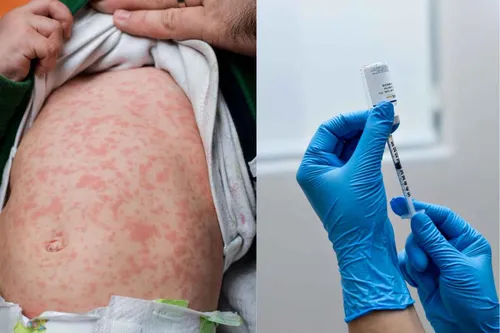 Município reforça vacina contra doença viral contagiosa